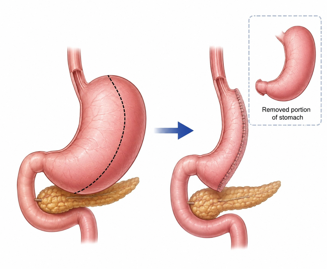 Gastrectomy